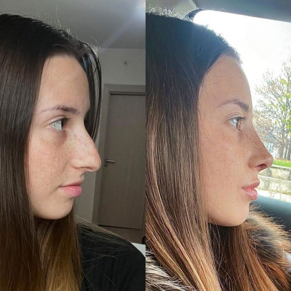 Rhinoplasty in Turkey • Dr. Selim Turan