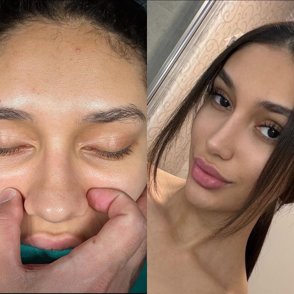 selim-turan-ethnic-nose-job