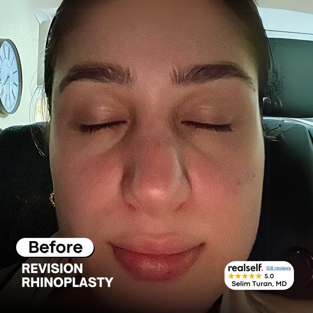 revision-rhinoplasty1