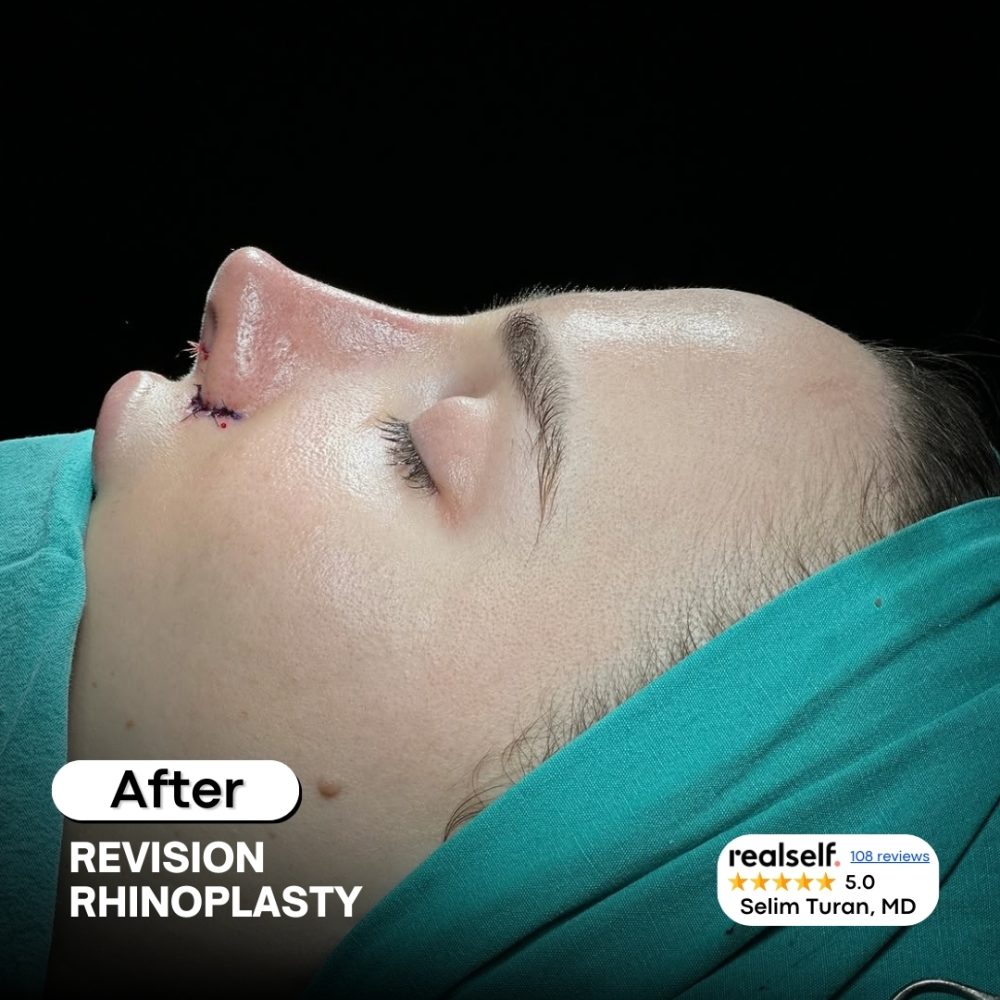 revisionrhinoplasty10