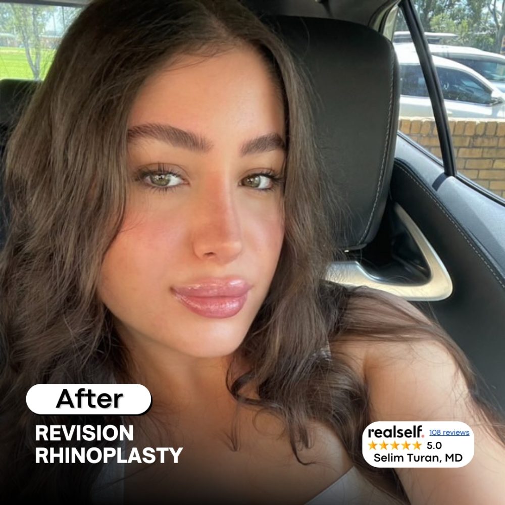 revisionrhinoplasty2