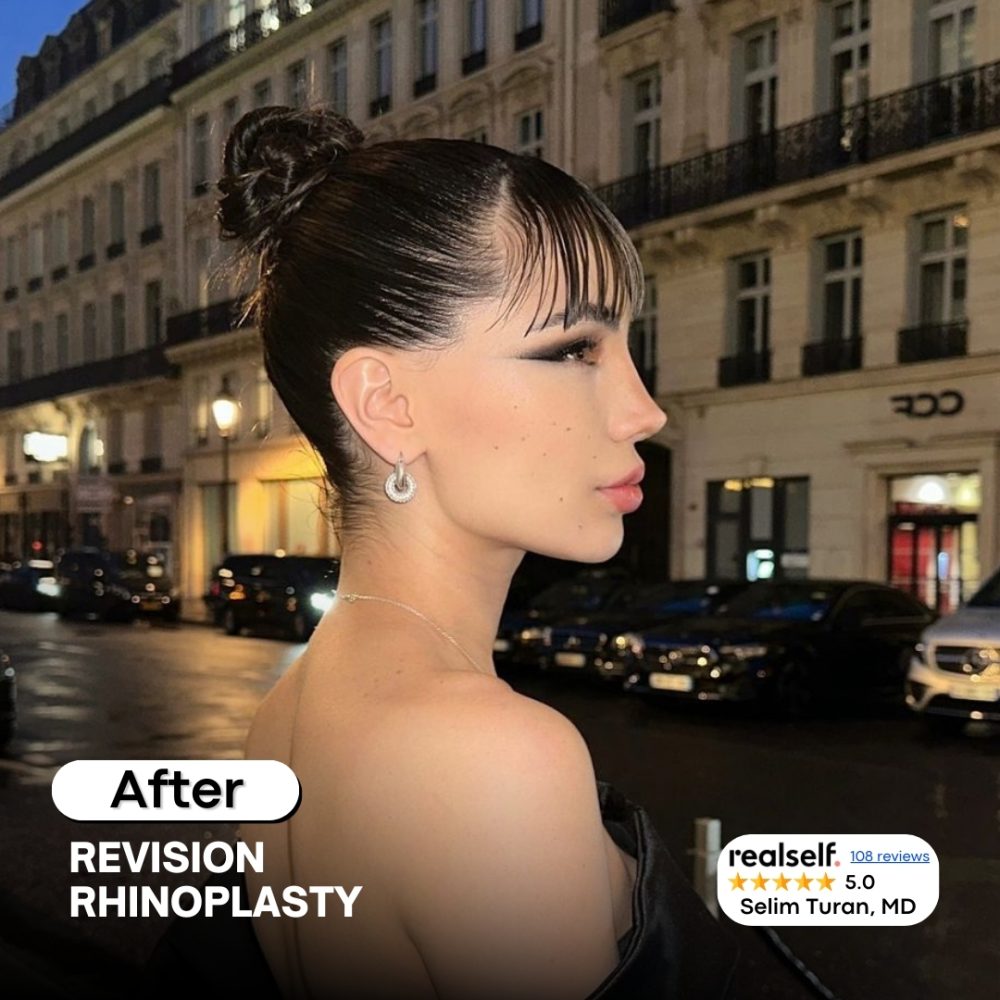 revisionrhinoplasty4