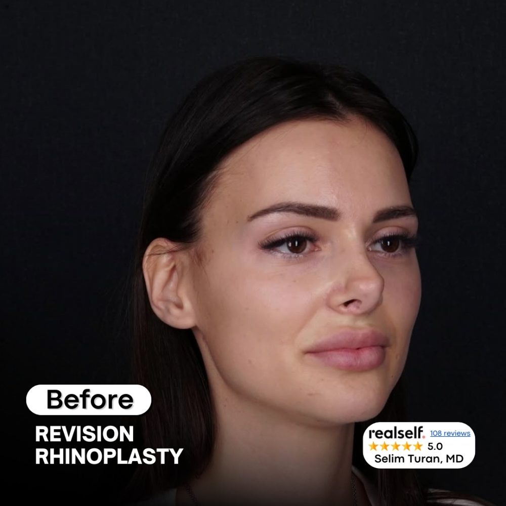 revisionrhinoplasty5