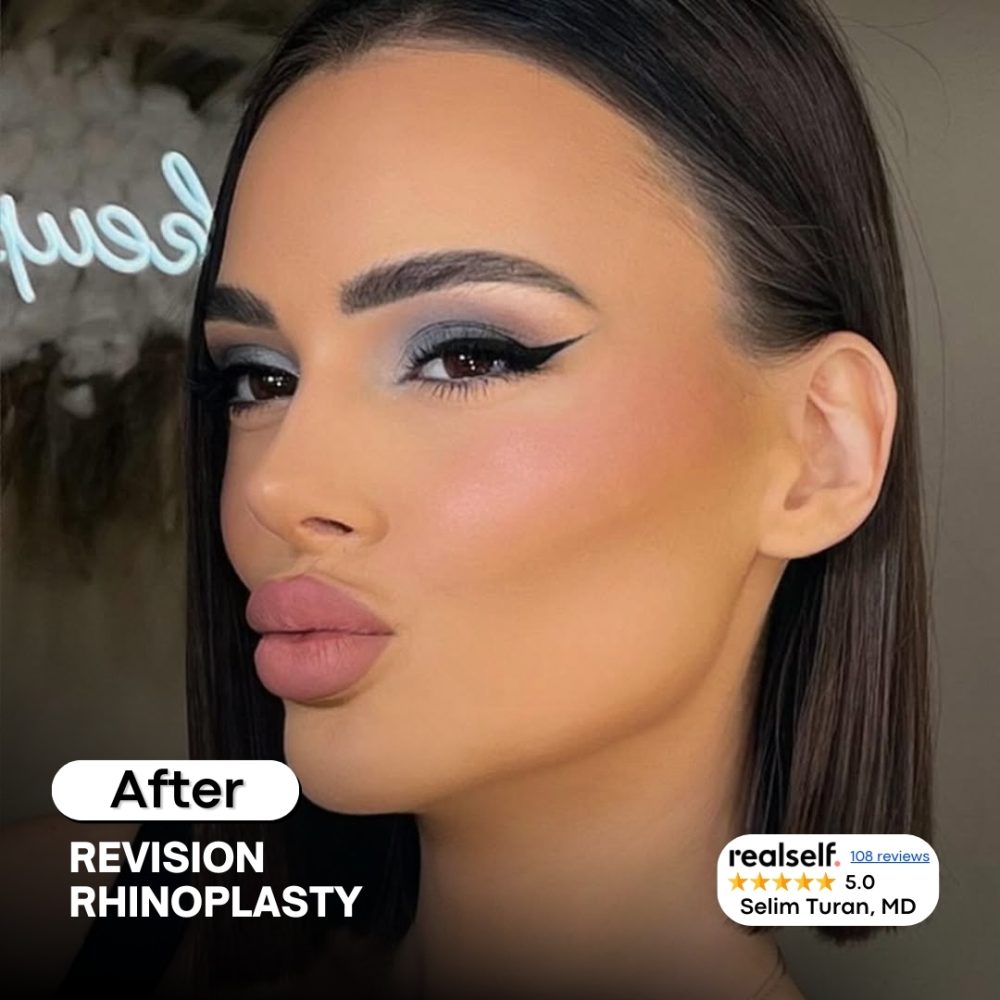 revisionrhinoplasty6