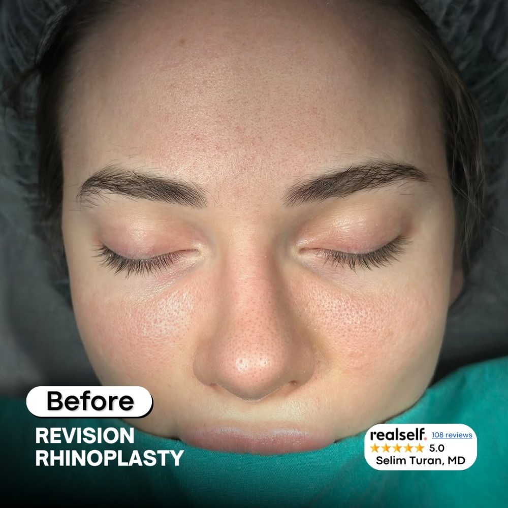 revisionrhinoplasty7