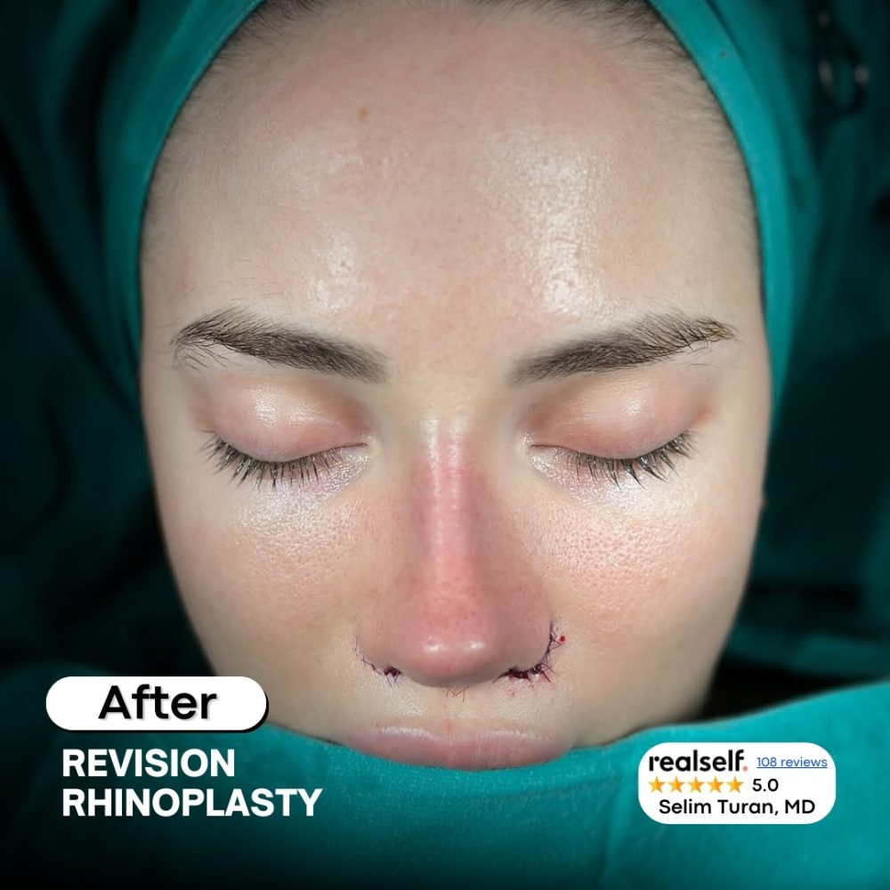 revisionrhinoplasty8