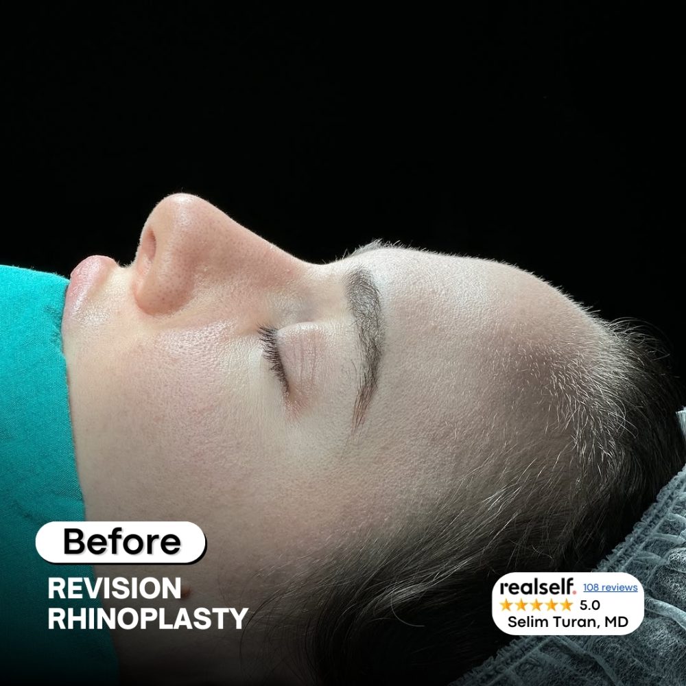 revisionrhinoplasty9